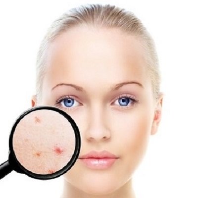Acne Causes & Treatments