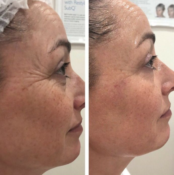 RADIOFREQUENCY FACELIFT AT RITUAL SKIN CLINICS IN ALTON AND ALRESFORD