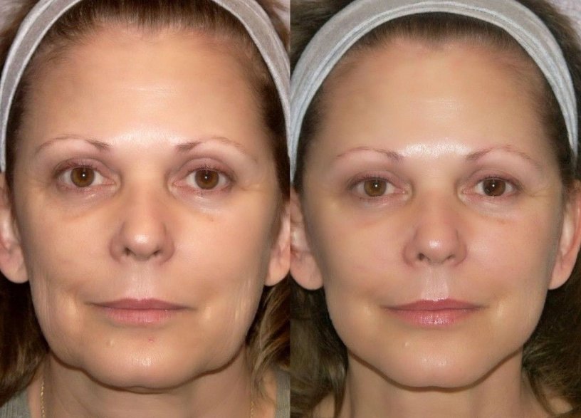 radiofrequency skin tightening facelifts at best beauty salons in Hampshire