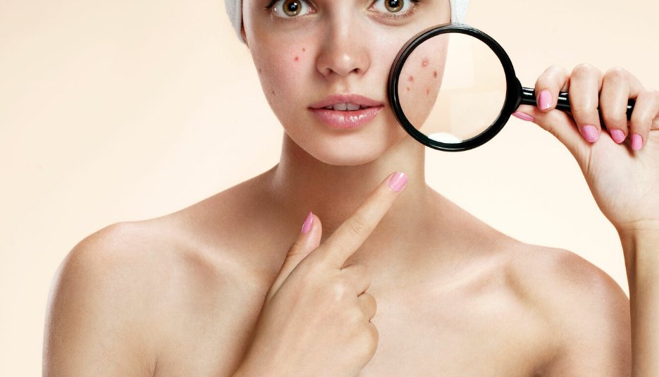 acne treatments at RITUAL skin clinics in Hampshire