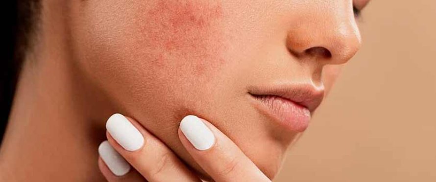acne treatments at the best skin clinics in Hampshire