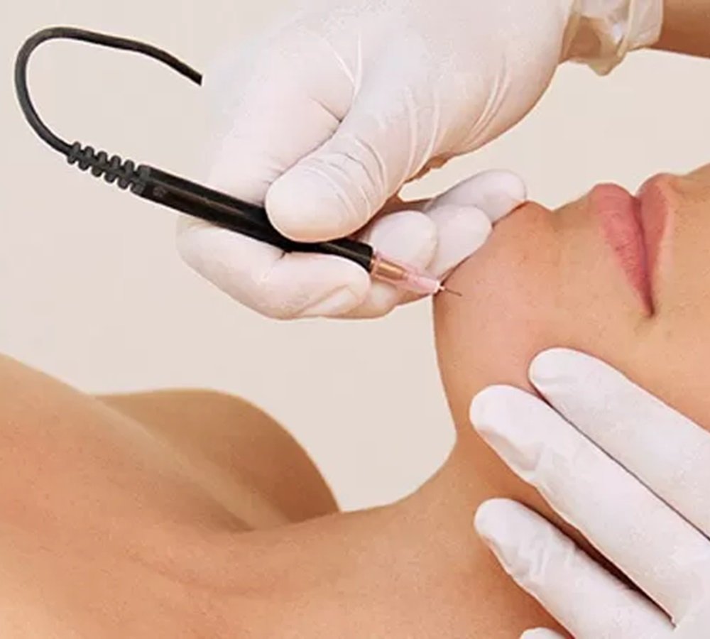 Electrolysis at RITUAL Beauty Salons in Alton and Alresford