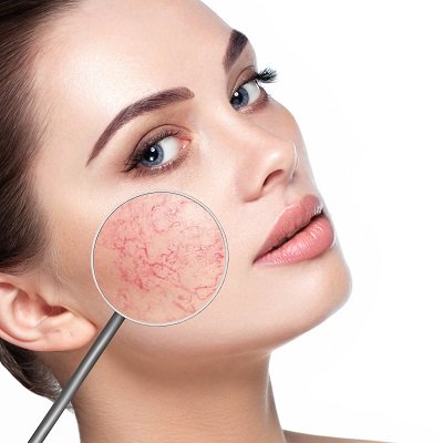 How To Improve Rosacea