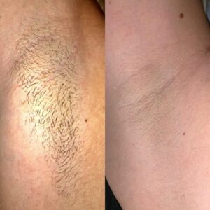 Laser Hair Removal Treatment at RITUAL Skin Beauty Clinic in Hampshire