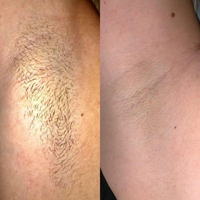 Laser Hair Removal at RITUAL Skin & Beauty Clinic in Hampshire