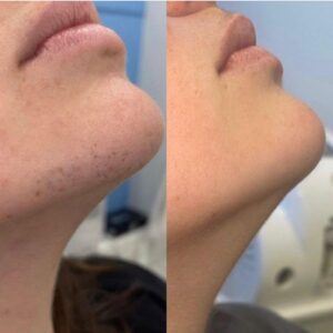 Laser Hair Removal Treatments at RITUAL Skin Beauty Clinic in Hampshire