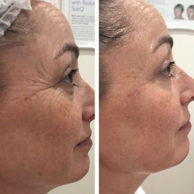 The Non-Surgical Face Lift