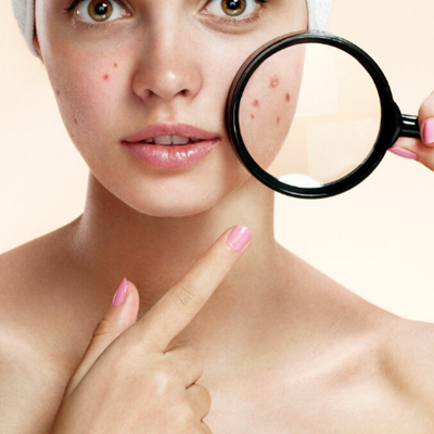 Bust Those Acne Myths!