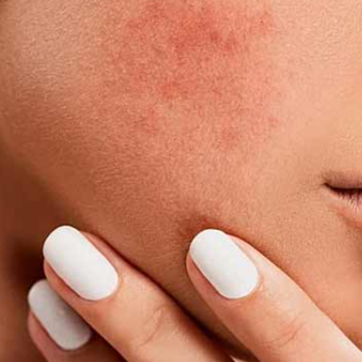 Why Do I Have Spots?
