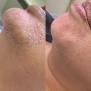 Laser Hair Removal at RITUAL Skin Beauty Clinic in Hampshire