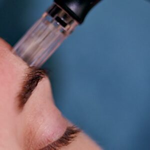 Microneedling Alton