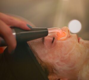 Rosacea resurfacing treatment Alton