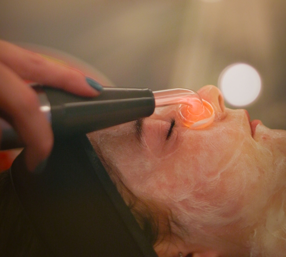 Rosacea resurfacing treatment Alton