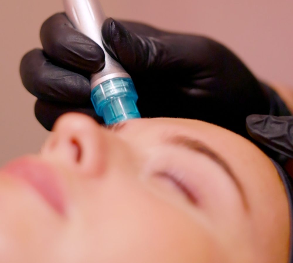 Microneedling at RITUAL Salons in Alton and Alresford Microneedling at RITUAL Salons in Alton and Alresford