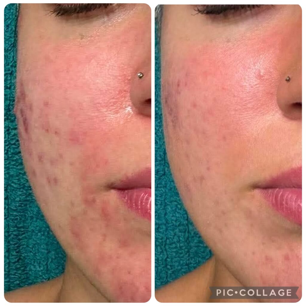 Acne before and after treatments at Ritual Beauty Salon in Hampshire Acne before and after treatments at Ritual Beauty Salon in Hampshire