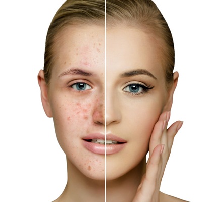 acne treatments at Ritual Beauty Spa in Alton and Alresford acne treatments at Ritual Beauty Spa in Alton and Alresford
